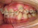 大人の治療（永久歯の本格的な矯正治療・第二期治療）